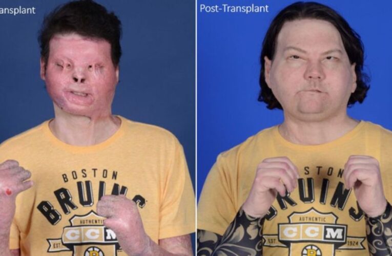 El primer trasplante de rostro y manos del mundo le da a un hombre de Nueva Jersey una segunda oportunidad en la vida